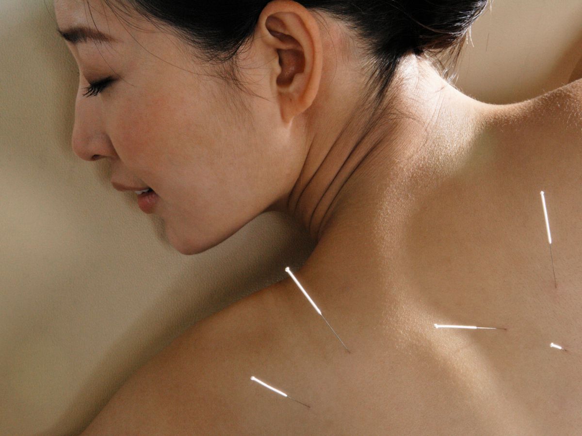 Acupuncture